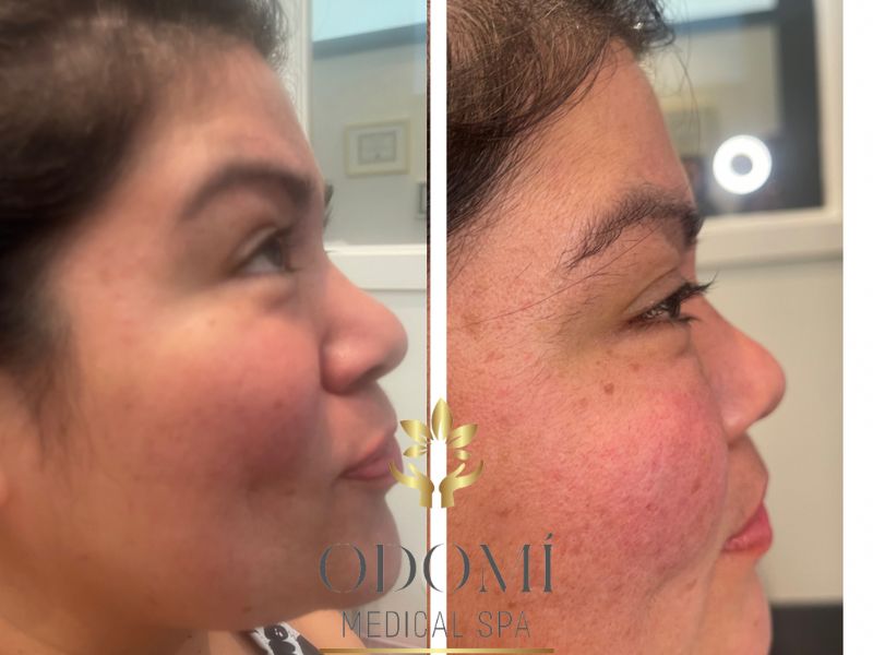Tear Trough Treatment Before and After Right Angle View Photos | Odomi Medical Spa in Savannah, GA