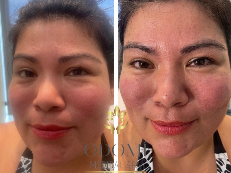 Tear Trough Treatment Before and After Front View Photos | Odomi Medical Spa in Savannah, GA