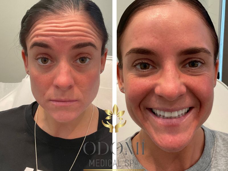 Botox Before and After Photos | Odomi Medical Spa in Savannah, GA