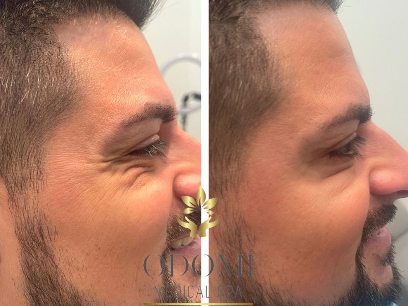 Young Man Before and After Botox Treatment Result | Odomí Medical Spa in Savannah, GA