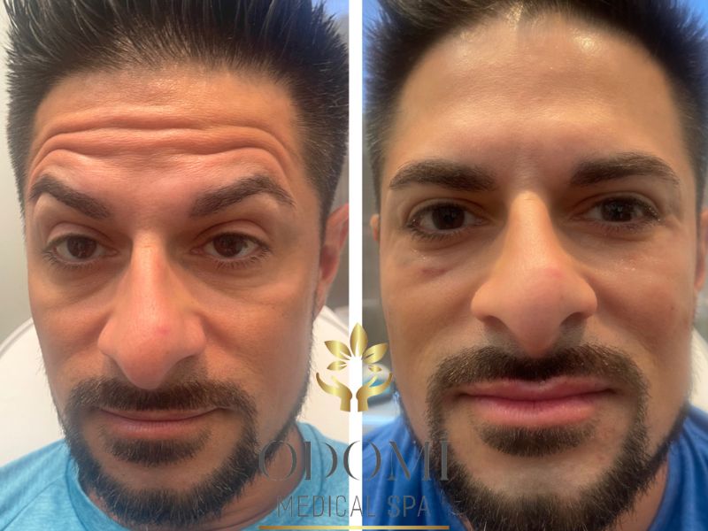 Male Botox Before and After Photos | Odomi Medical Spa in Savannah, GA