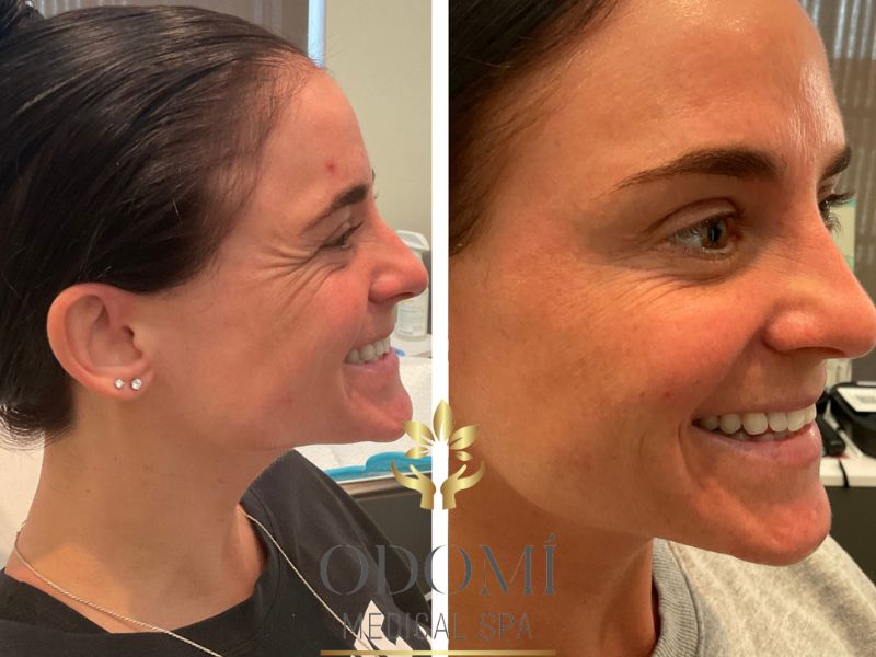 Female Botox Before and After Photos | Odomi Medical Spa in Savannah, GA
