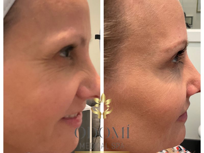 Young Female Before and After Botox Treatment Photo | Odomí Medical Spa in Savannah, GA
