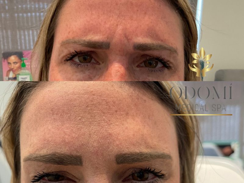 Young Female Before and After Botox Treatment Photo | Odomí Medical Spa in Savannah, GA