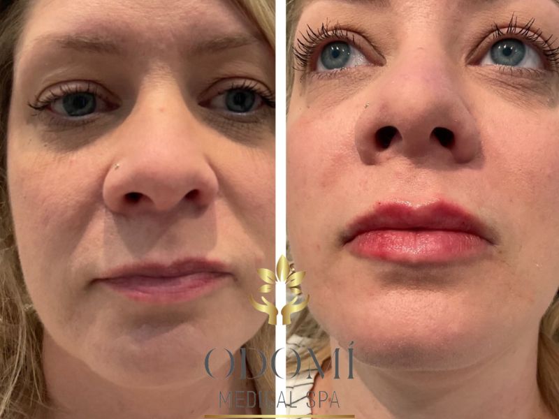 Lip Filler Before and After Photos | Odomi Medical Spa in Savannah, GA