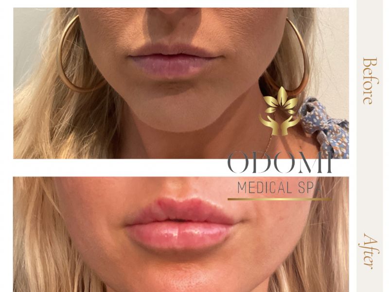 Woman Lip Filler Before and After Front View Photos | Odomi Medical Spa in Savannah, GA