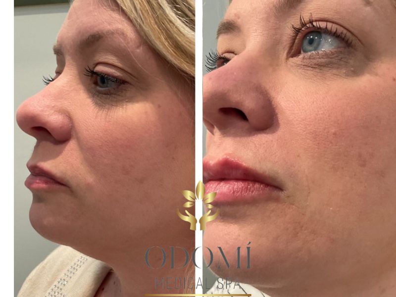 Woman Lip Filler Before and After Photos | Odomi Medical Spa in Savannah, GA