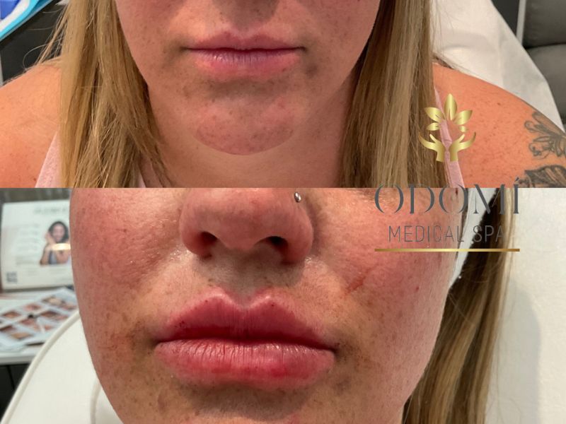 Young Female Before and After Lip Filler Treatment Photo | Odomí Medical Spa in Savannah, GA