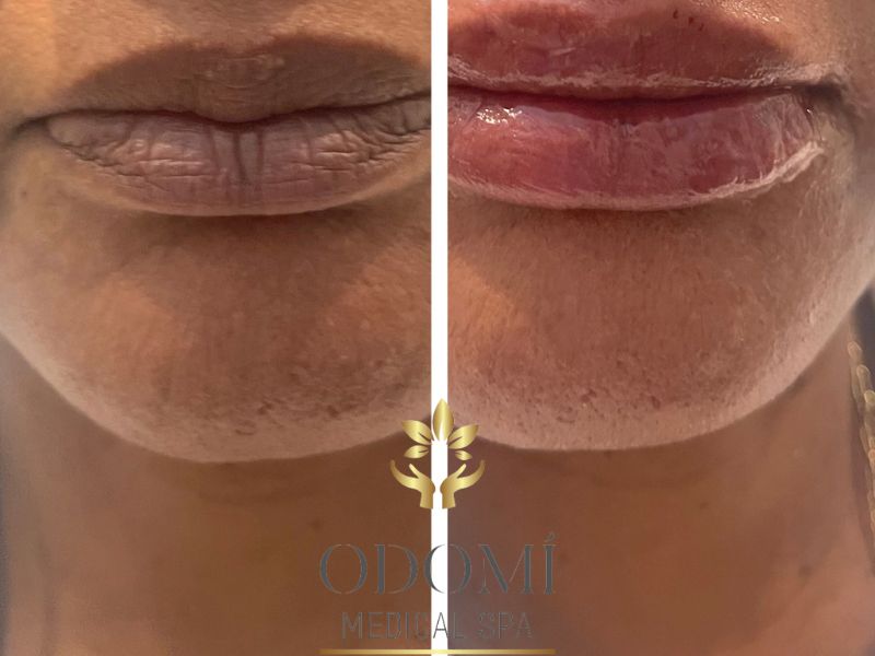 Lip Filler Before and After Photos | Odomi Medical Spa in Savannah, GA