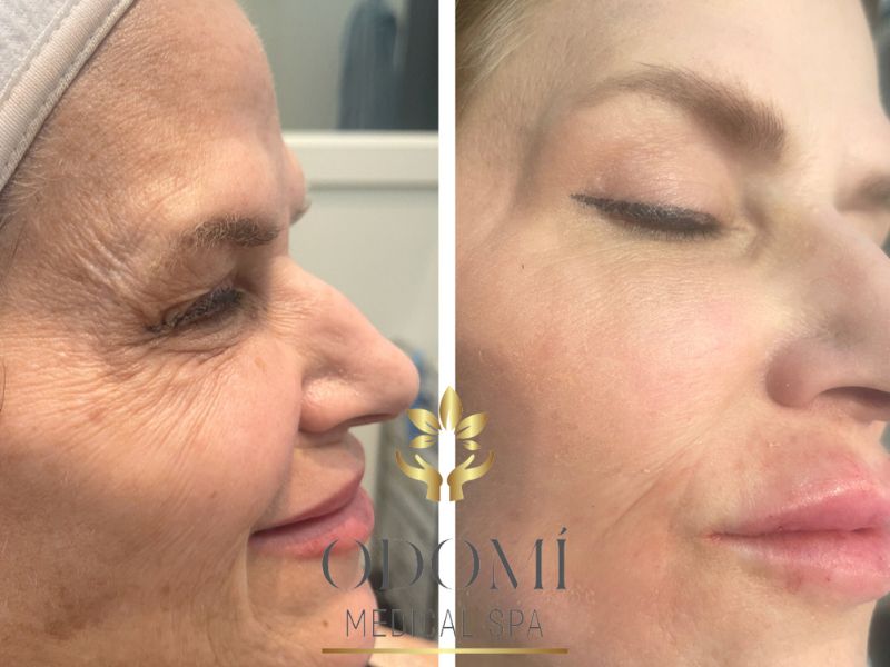 Female Lip Filler Before and After Photos | Odomi Medical Spa in Savannah, GA