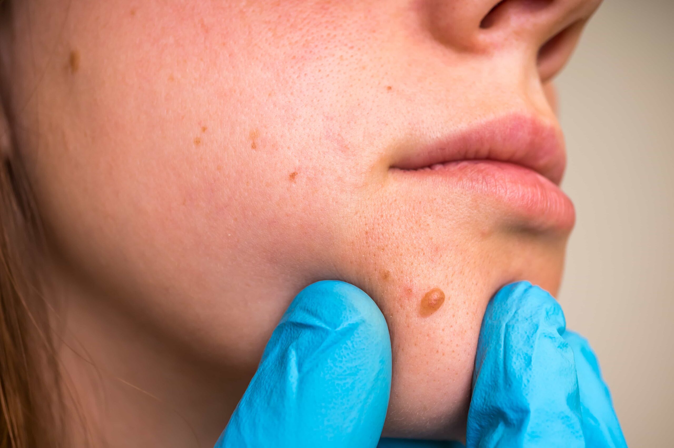 Skin Tag Removal Effective and Safe Methods for Clear Skin