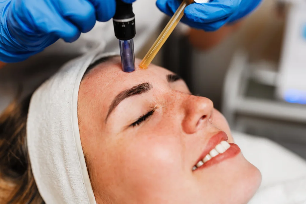 Microneedling with PRF in Savannah, GA