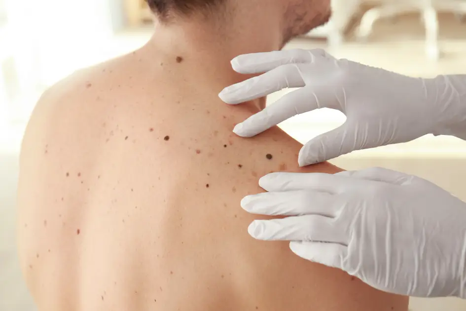 Top Causes of Skin Tags You Should Know