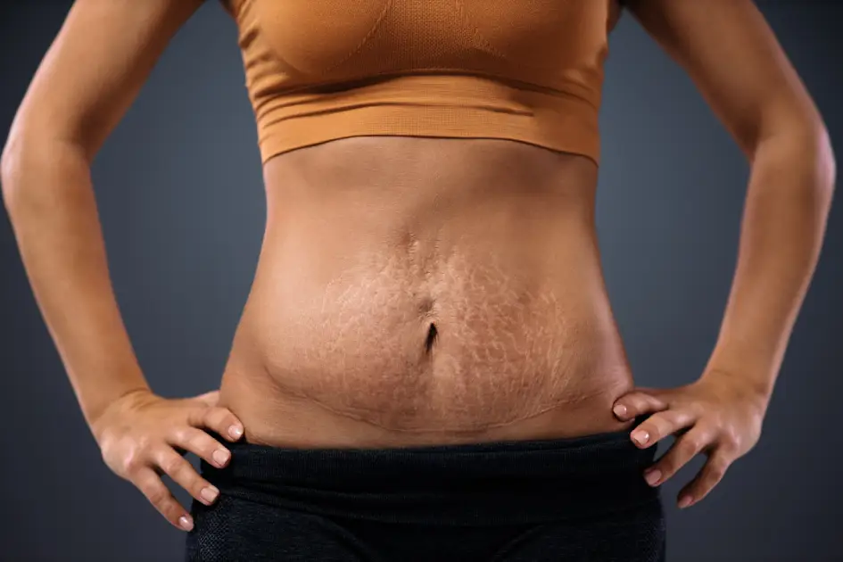 RF Microneedling for Stretch Marks: What You Need to Know