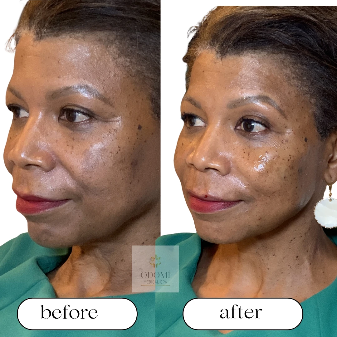 Before-After
