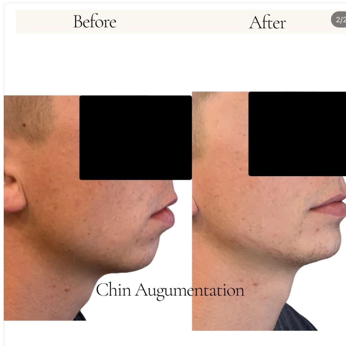 Chin-Augumentation-Before-After