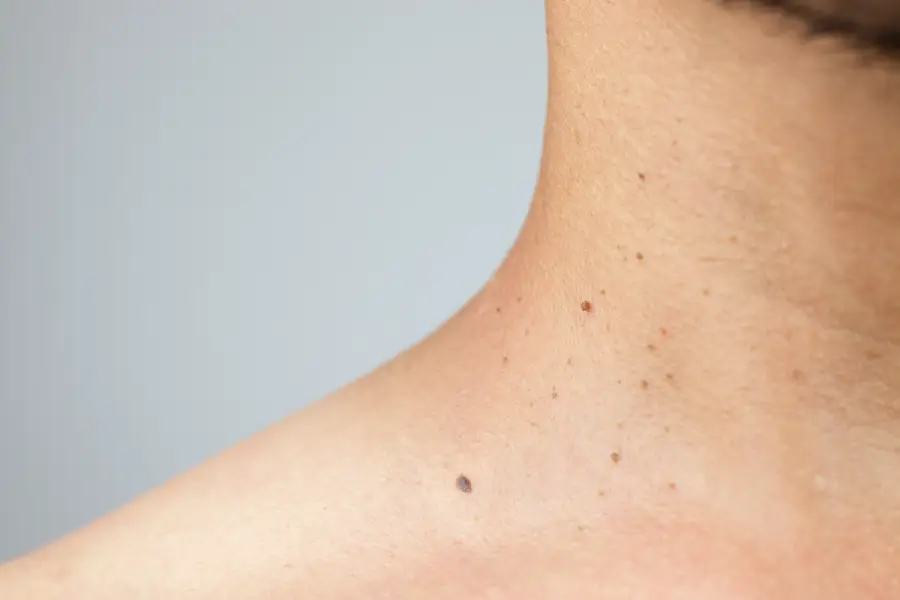Is Skin Tag Removal Safe? Side Effects, Scarring & What to Know