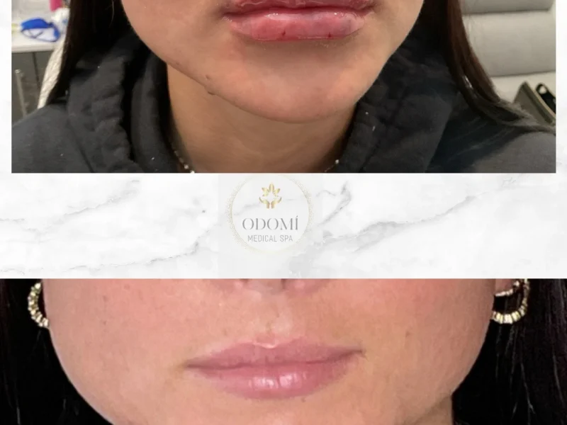 Before after image lip filler treatment in Savannah, GA